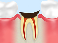 【C4：歯根に達した虫歯】